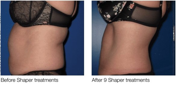 body contouring before and after with 3deep