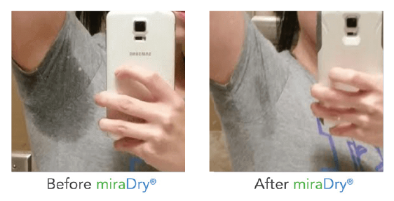 treat hyperhidrosis excessive sweating McAllen… MiraDry McAllen