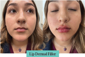 dermal filler mcallen texas lip enhancement before and after