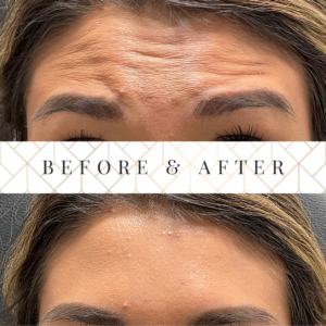 Before and After Results with Botox