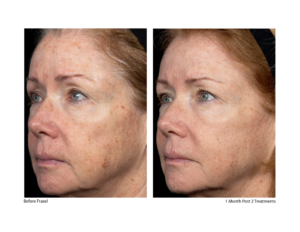 fraxel before and after pigmentation 
