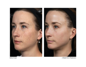 before and after fraxel laser skin resurfacing 