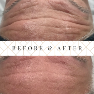 fraxel laser resurfacing before and after