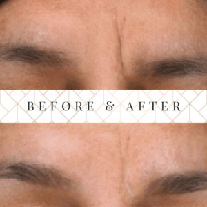 laser skin resurfacing before and after wrinkle on glabella