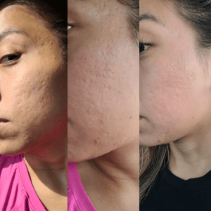 fraxel skin laser resurfacing on the cheek