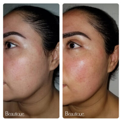 After just ONE treament of Thermage Skin Tightening