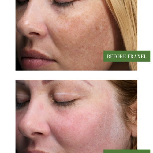 fraxel laser skin resurfacing before and after freckles