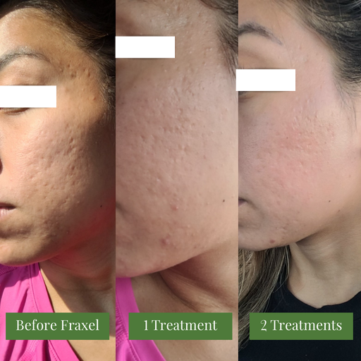 fraxel treatment - COLLAGEN STIMULATION TREATMENT