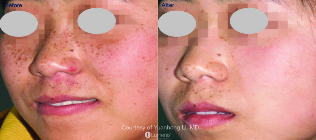 freckles removal with fotofacial (ipl)