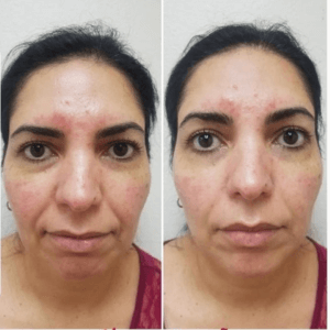 rosacea treatment with ipl fotofacial in mcallen, texas