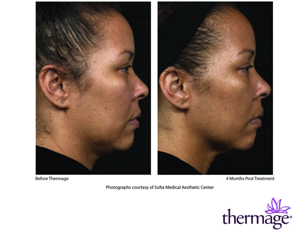 COLLAGEN STIMULATION TREATMENT WITH THERMAGE