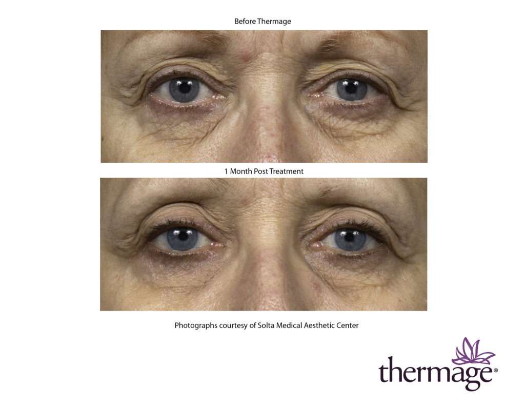 THERMAGE - COLLAGEN STIMULATION TREATMENT