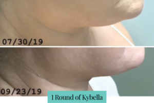 kybella before and after in mcallen
