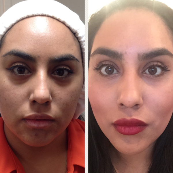 liquid facelift in the mid-face in mcallen tx