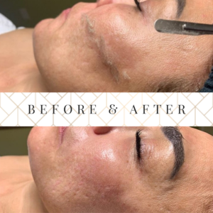 McAllen Dermaplaning Facial