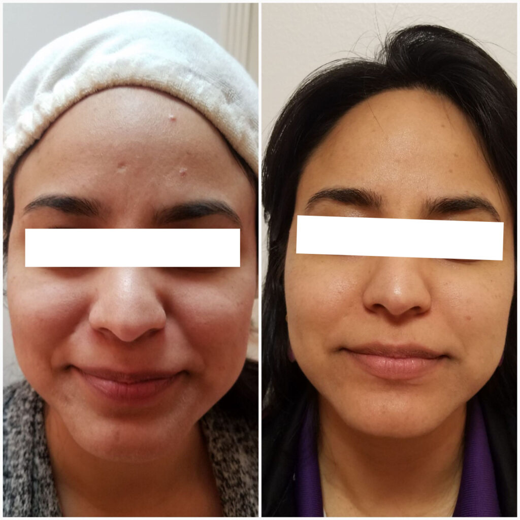 before and after vi peel treatment