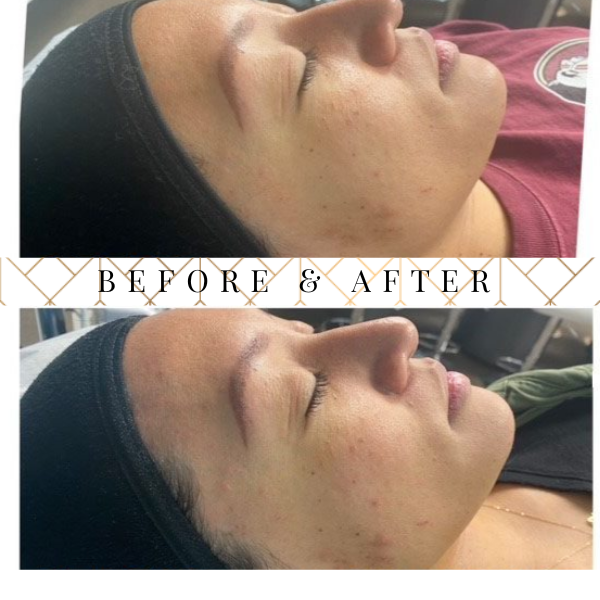 TLI - TOPICAL LIGHT INFUSION FACIAL BEFORE & AFTER