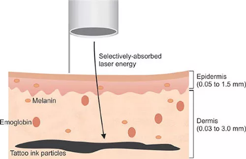 Skin Layers - Understanding Tattoo Removal