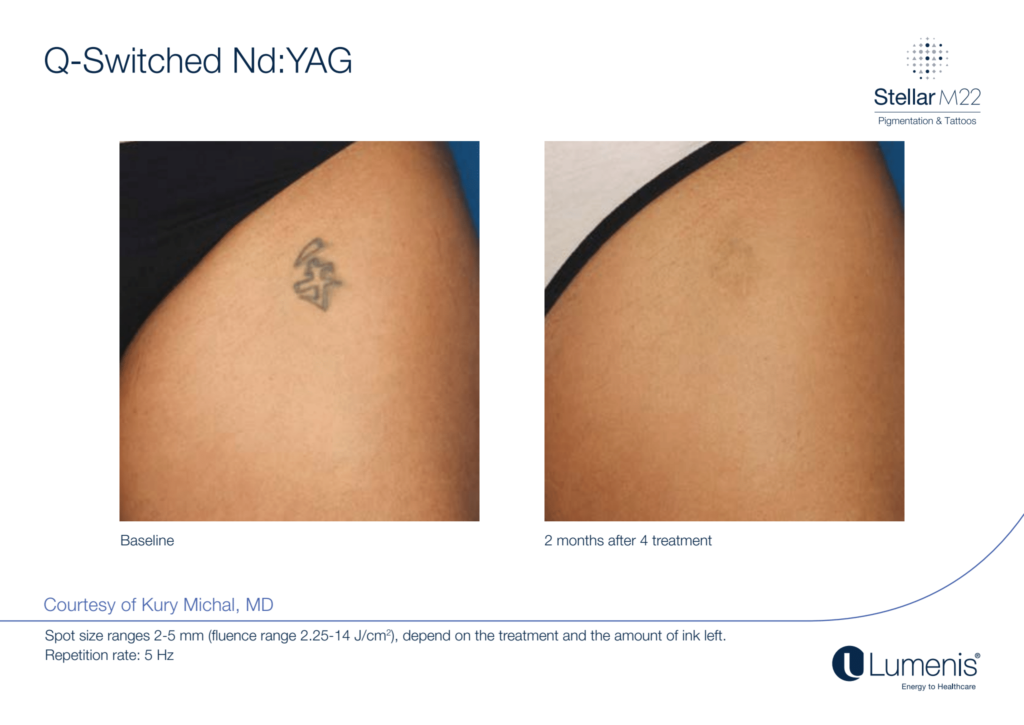 Tattoo Removal before and after with Q-Switch Laser