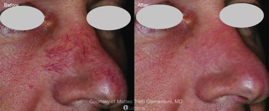 rosacea: spider veins can be treated with IPL