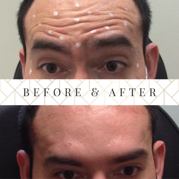 Before and After Results of Botox for Men in McAllen
