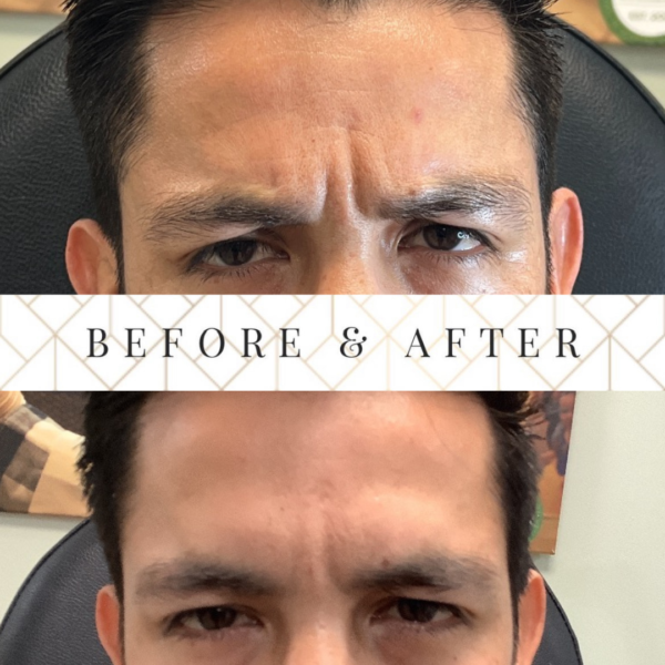 Before and After Results - Men Botox in McAllen