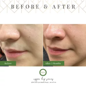 Before and After Laser Hair Removal of Upper Lip