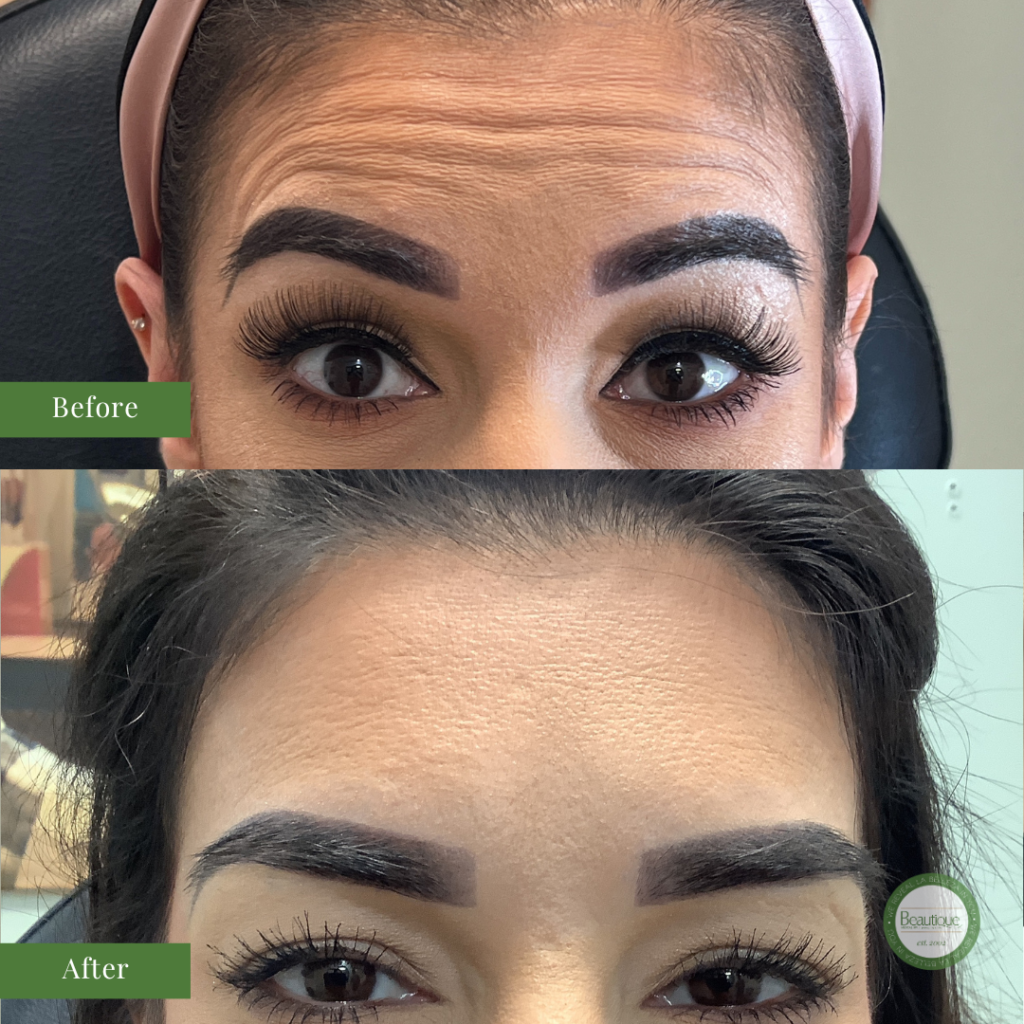 Botox in McAllen - Before and After Results of Client