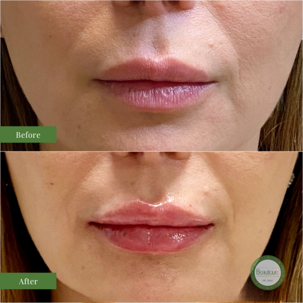 Before-and-After-Lips-Ultra