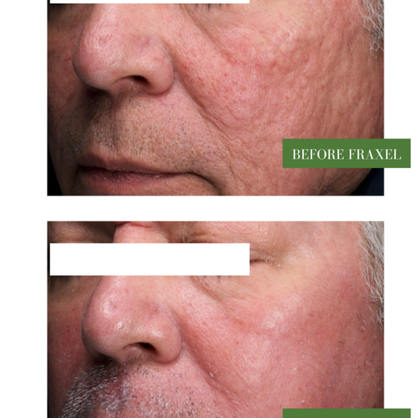 Fraxel Laser Skin Resurfacing Results - Acne Scars