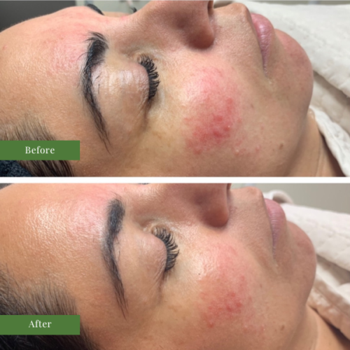 IPL RESULTS FOR ACNE TREATMENT
