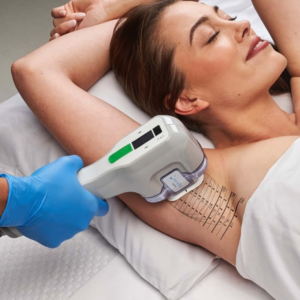 MiraDry for Excessive Sweating 75th Exclusive