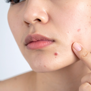 Vi Peel Purify for Acneic Skin 75th Exclusive