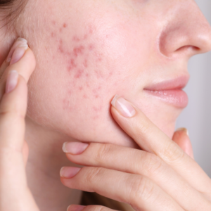 Fraxel Acne Scar Treatment