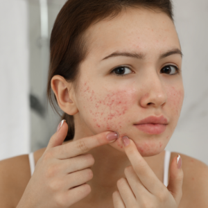 Acne Reset Program