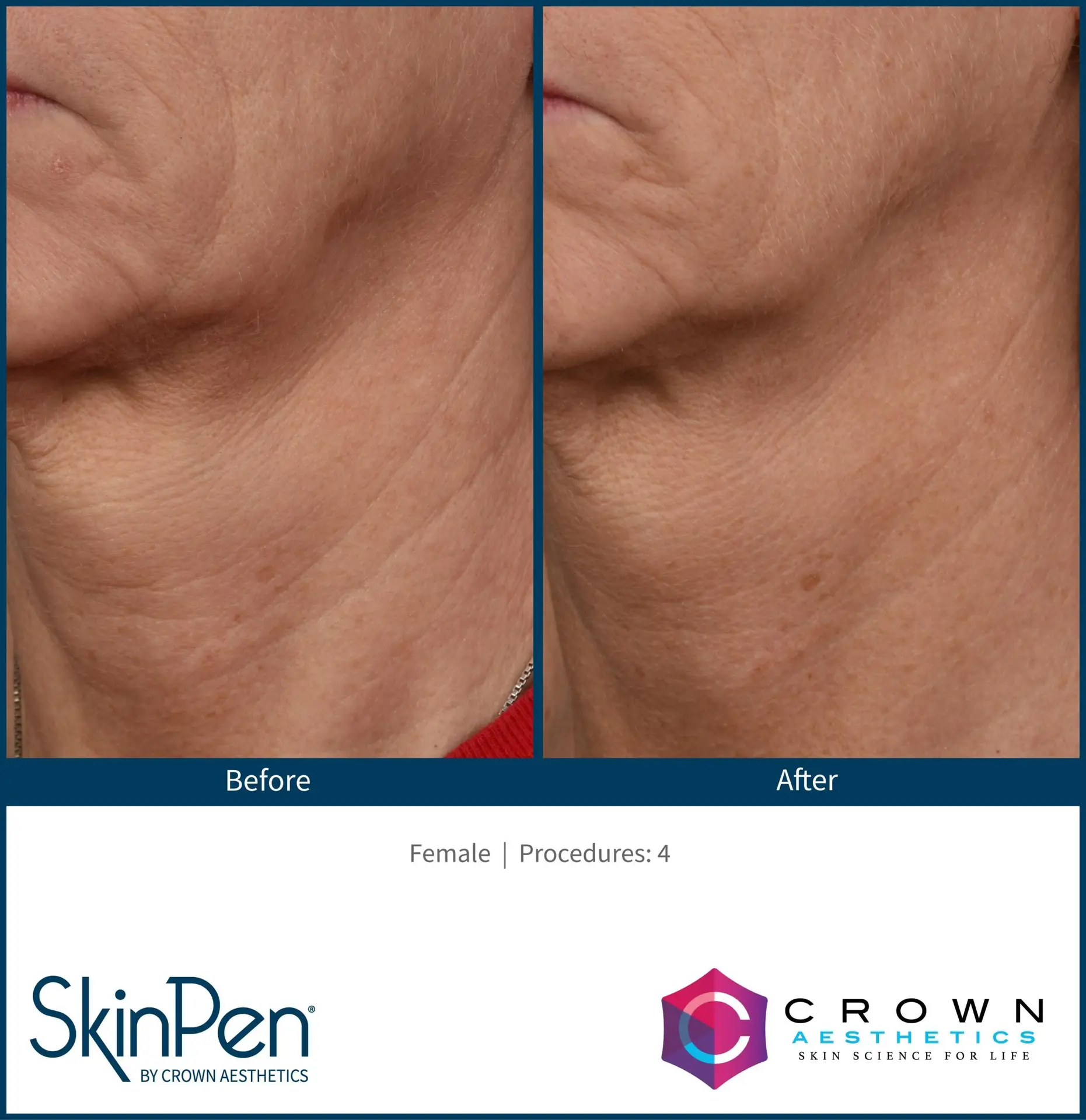 SkinPen® Microneedling 4 Beautique Medical Spa BA-SkinPen-FLAW_001_neck_vertical_RGB_300dpi