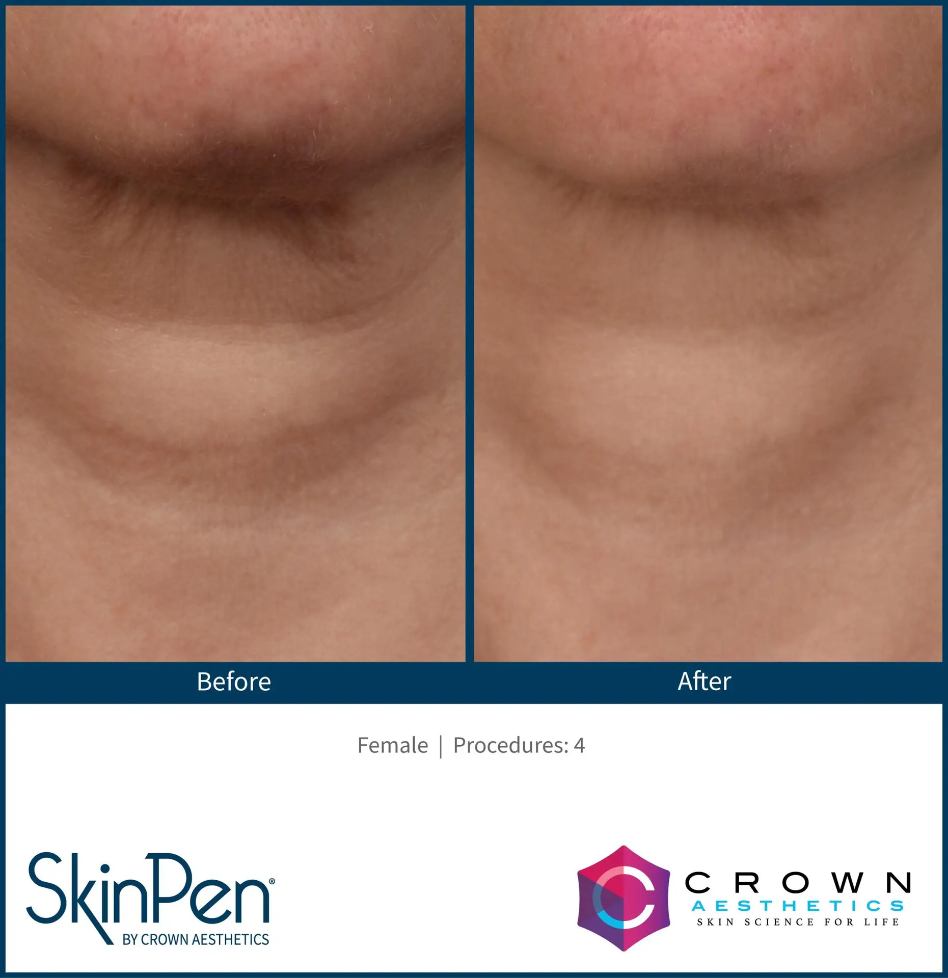 SkinPen® Microneedling 5 Beautique Medical Spa BA-SkinPen-FLAW_002_neck_RGB_300dpi