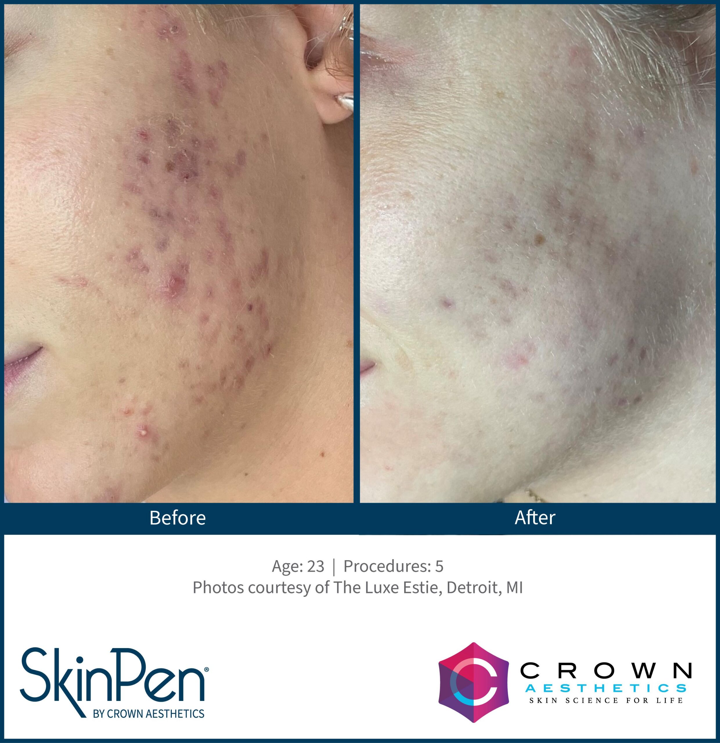 SkinPen® Microneedling 6 Beautique Medical Spa BA-SkinPen-TheLuxeEstie_Set3_Age23_Treatments5
