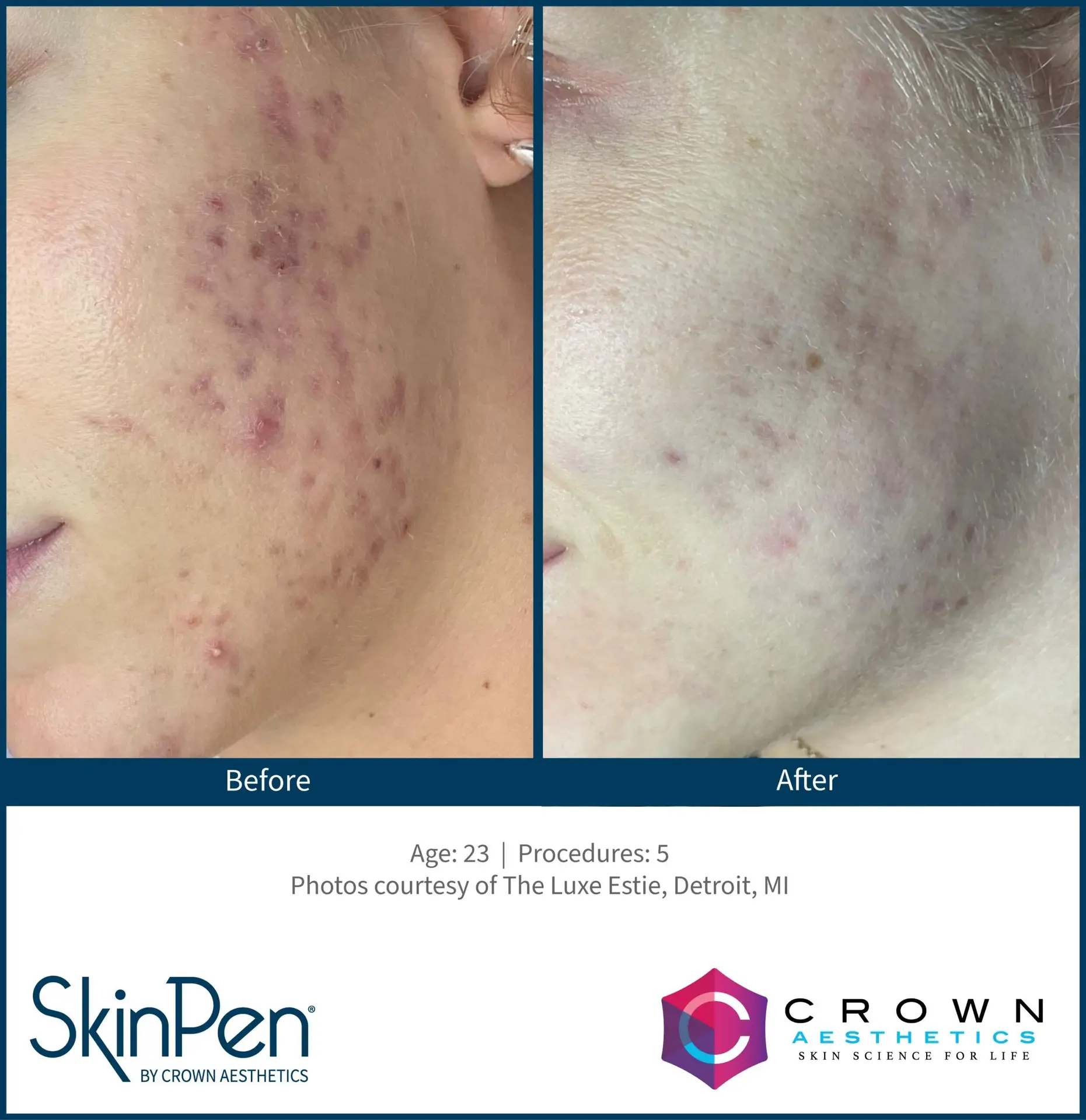 SkinPen® Microneedling 6 Beautique Medical Spa BA-SkinPen-TheLuxeEstie_Set3_Age23_Treatments5