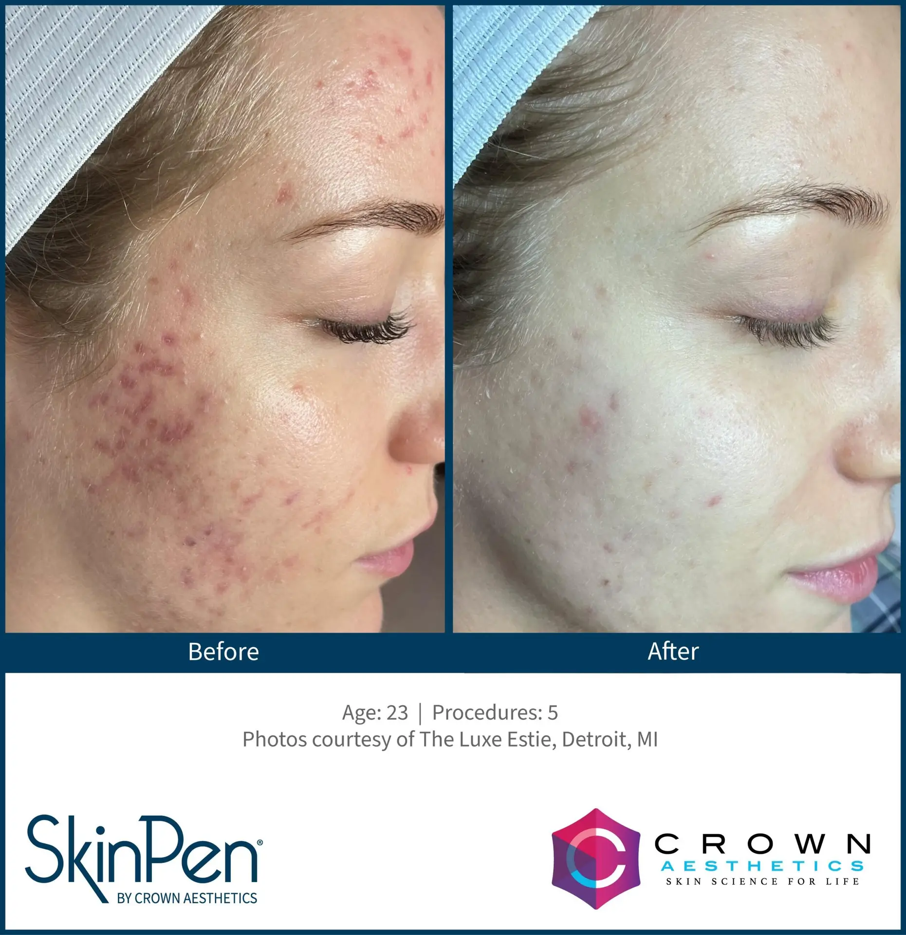 SkinPen® Microneedling 7 Beautique Medical Spa BA-SkinPen-TheLuxeEstie_Set4_Age23_Treatments5
