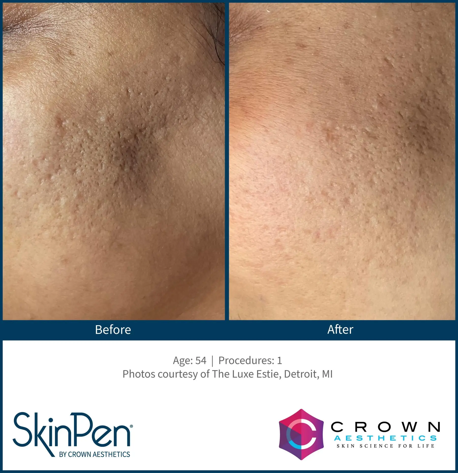 SkinPen® Microneedling 8 Beautique Medical Spa BA-SkinPen-TheLuxeEstie_Set7_Age54_Treatments1