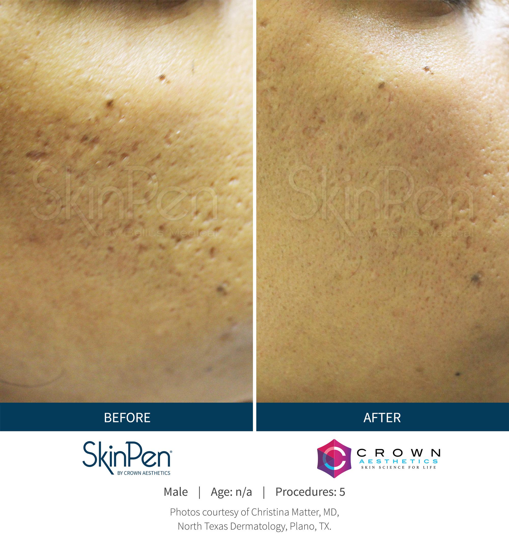 SkinPen® Microneedling 10 Beautique Medical Spa Before-and-After-Picture-CA-12