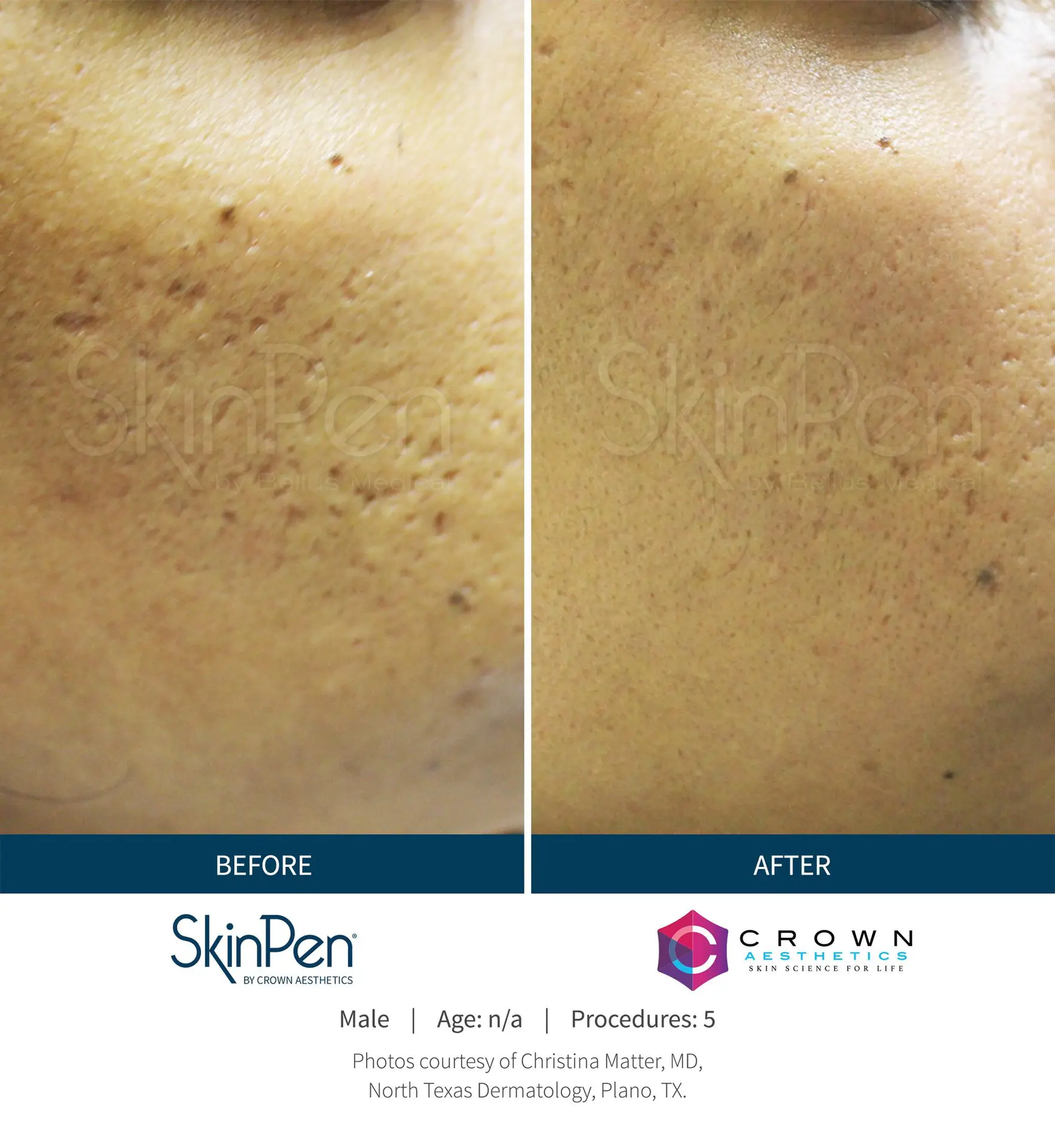 SkinPen® Microneedling 10 Beautique Medical Spa Before-and-After-Picture-CA-12