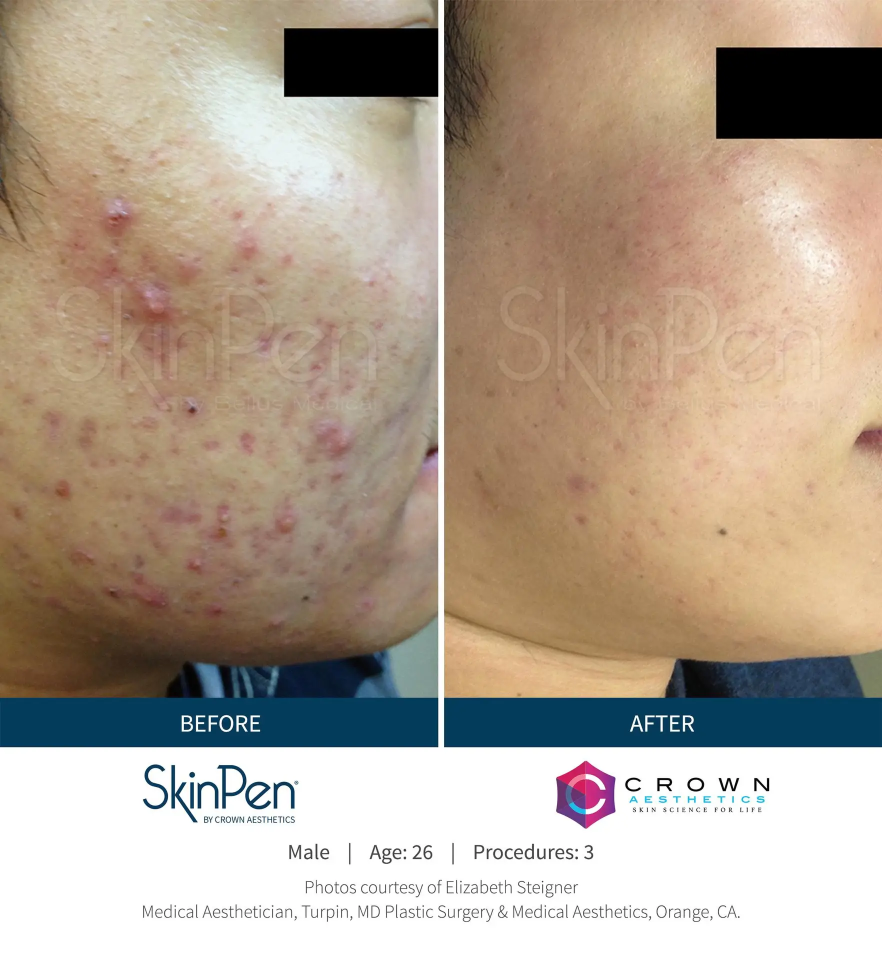 SkinPen® Microneedling 11 Beautique Medical Spa Before-and-After-Picture-CA-13