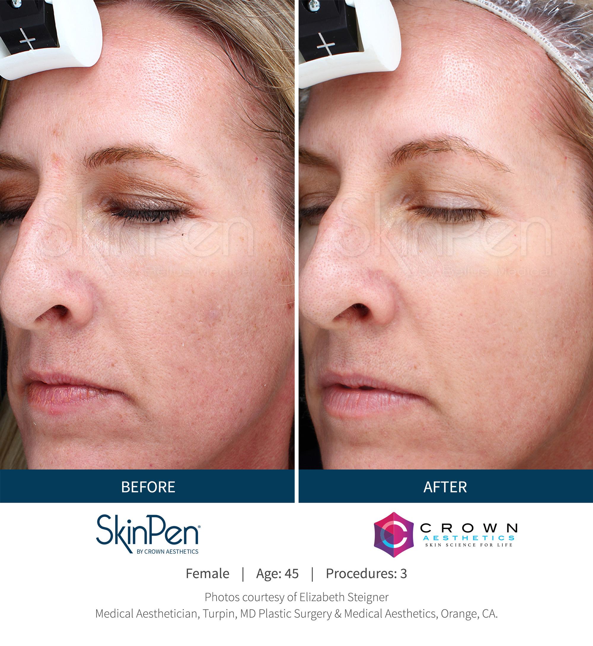 SkinPen® Microneedling 12 Beautique Medical Spa Before-and-After-Picture-CA-14