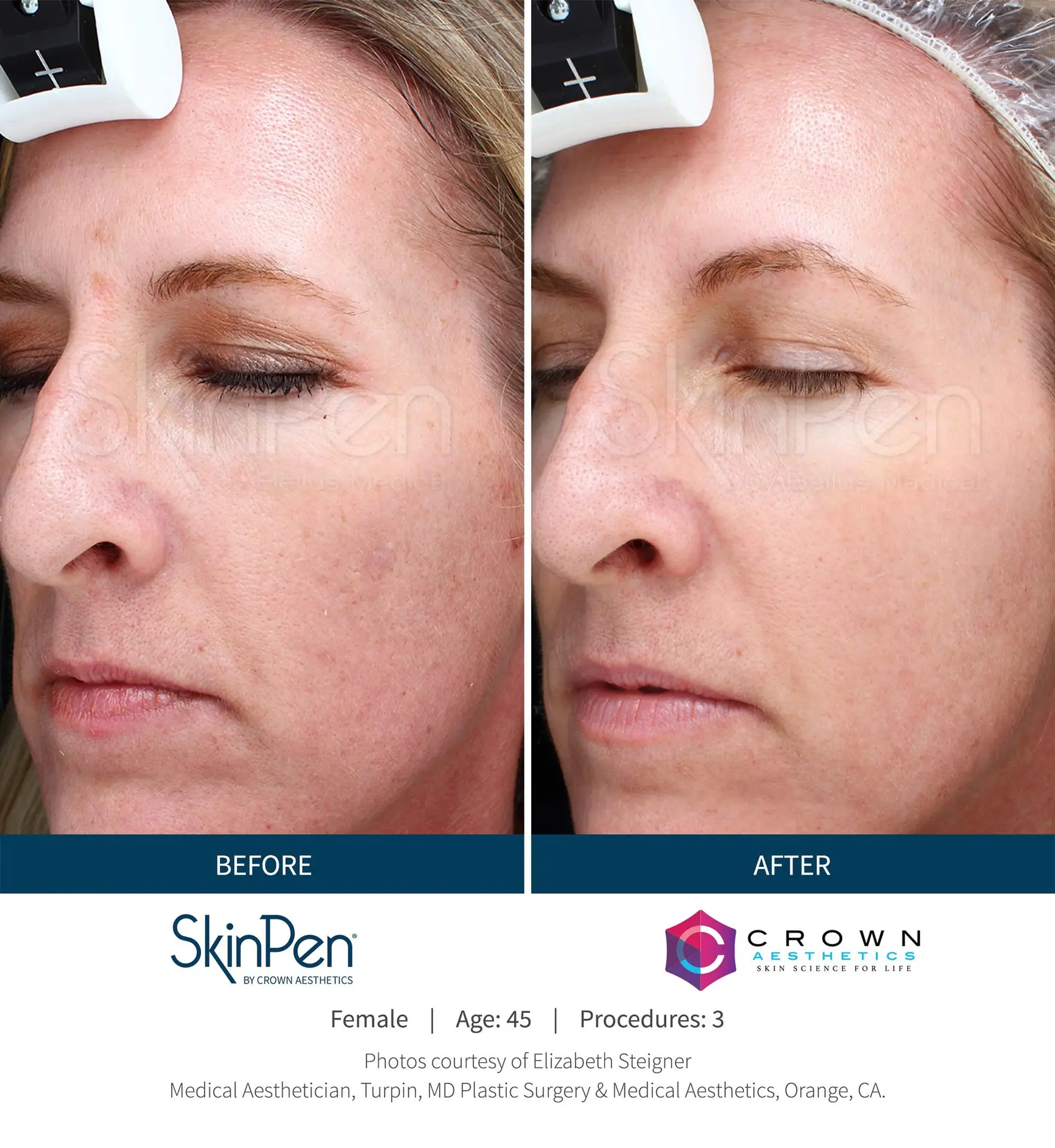 SkinPen® Microneedling 12 Beautique Medical Spa Before-and-After-Picture-CA-14