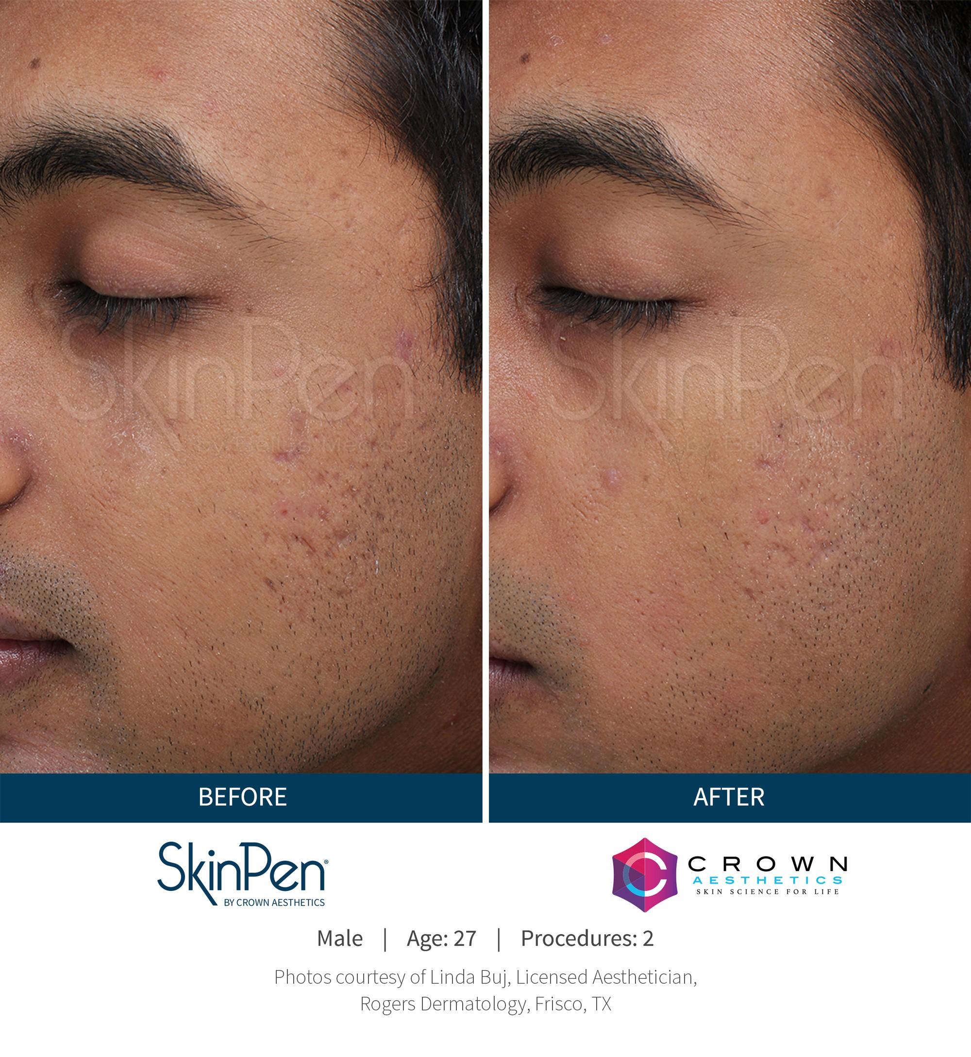 SkinPen® Microneedling 13 Beautique Medical Spa Before-and-After-Picture-CA-15