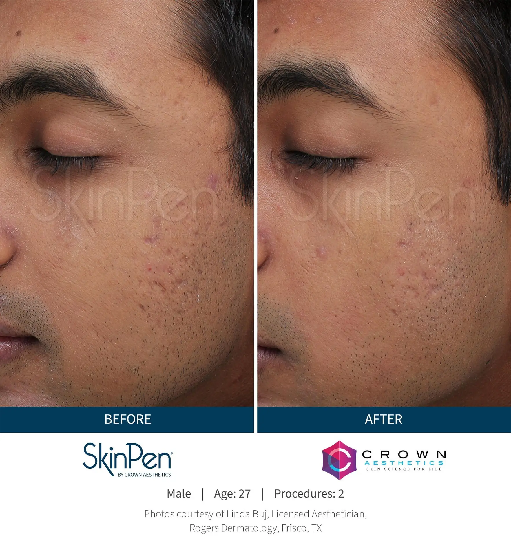 SkinPen® Microneedling 13 Beautique Medical Spa Before-and-After-Picture-CA-15