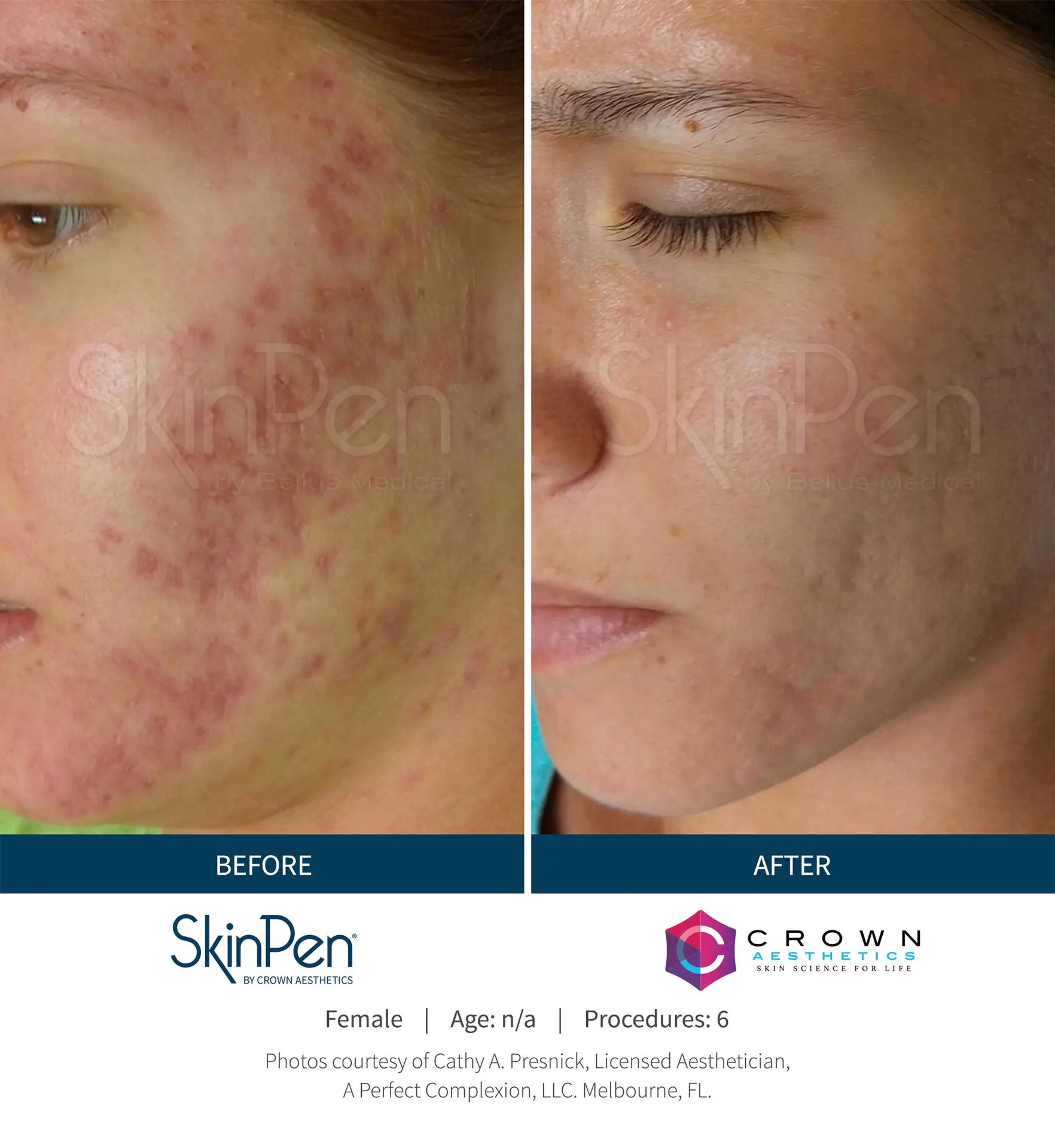 SkinPen® Microneedling 14 Beautique Medical Spa Before-and-After-Picture-CA-17