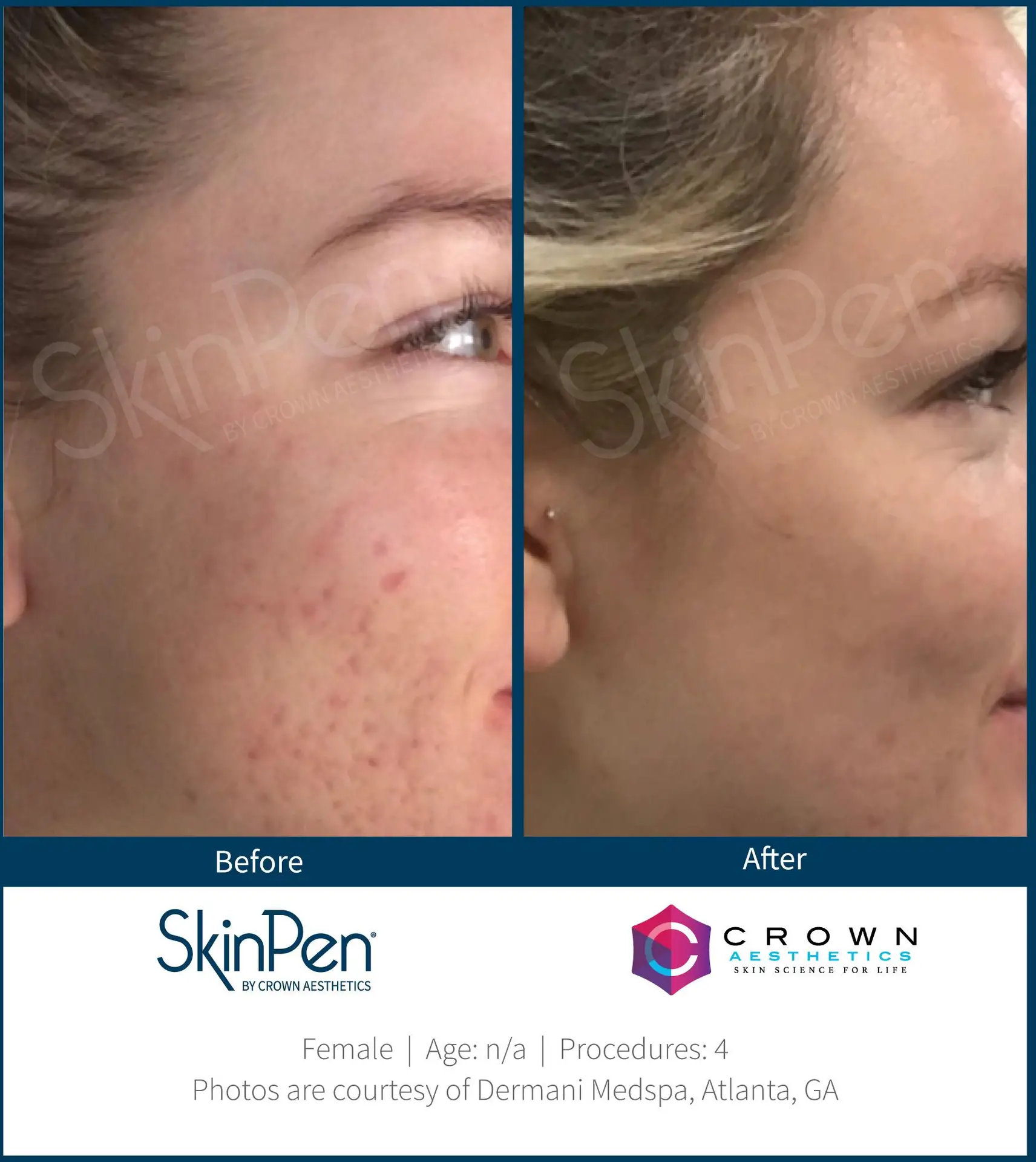SkinPen® Microneedling 9 Beautique Medical Spa Before-and-After-Picture-CA-9